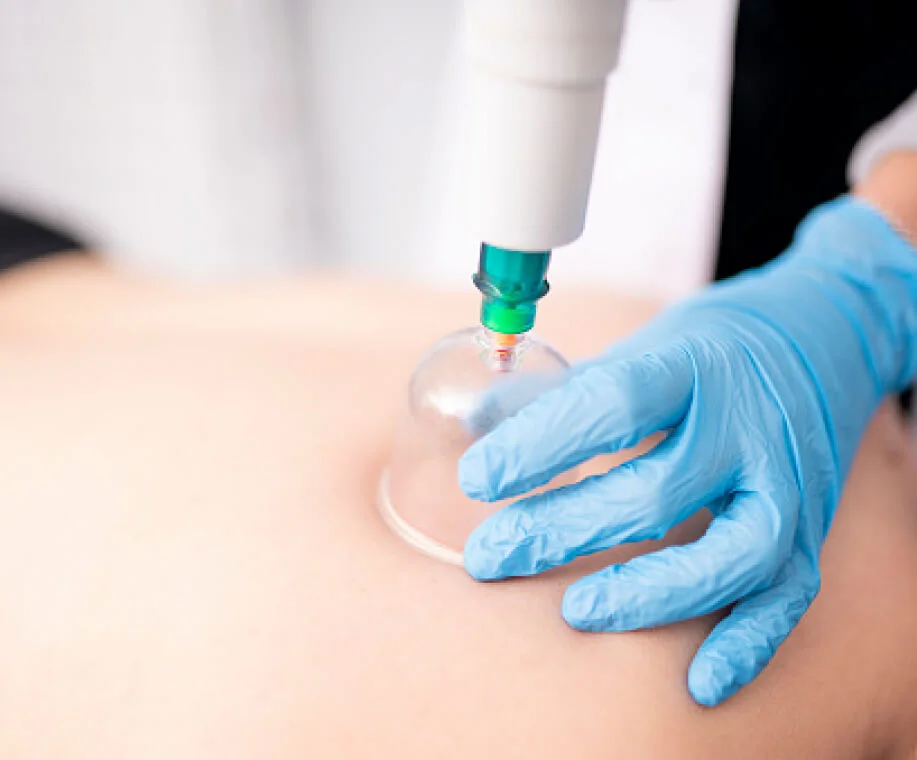 الحجامة الوقائية