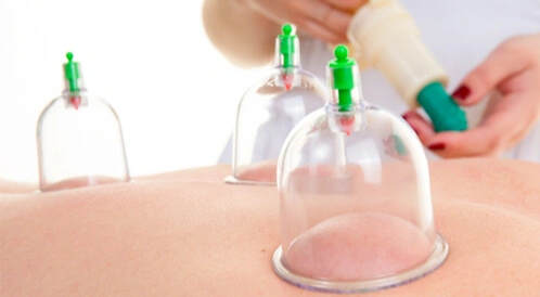 الحجامة والطب الحديث